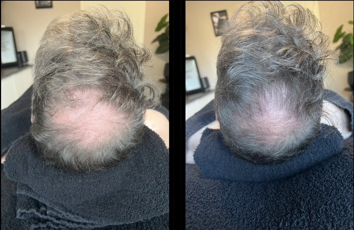 Voor en na Stamcel Hair Therapy bij PerfectSkin by Laura