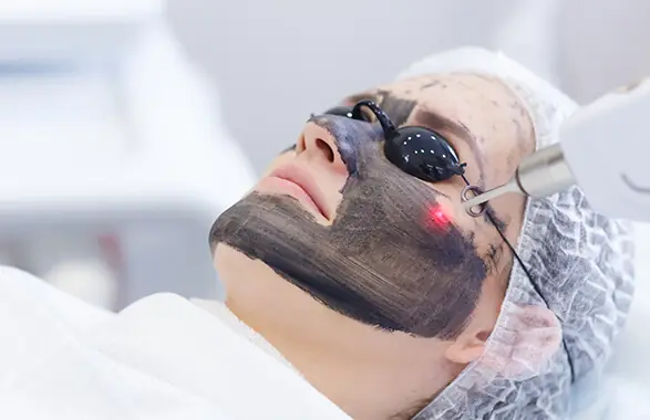 Carbon peel laserbehandeling