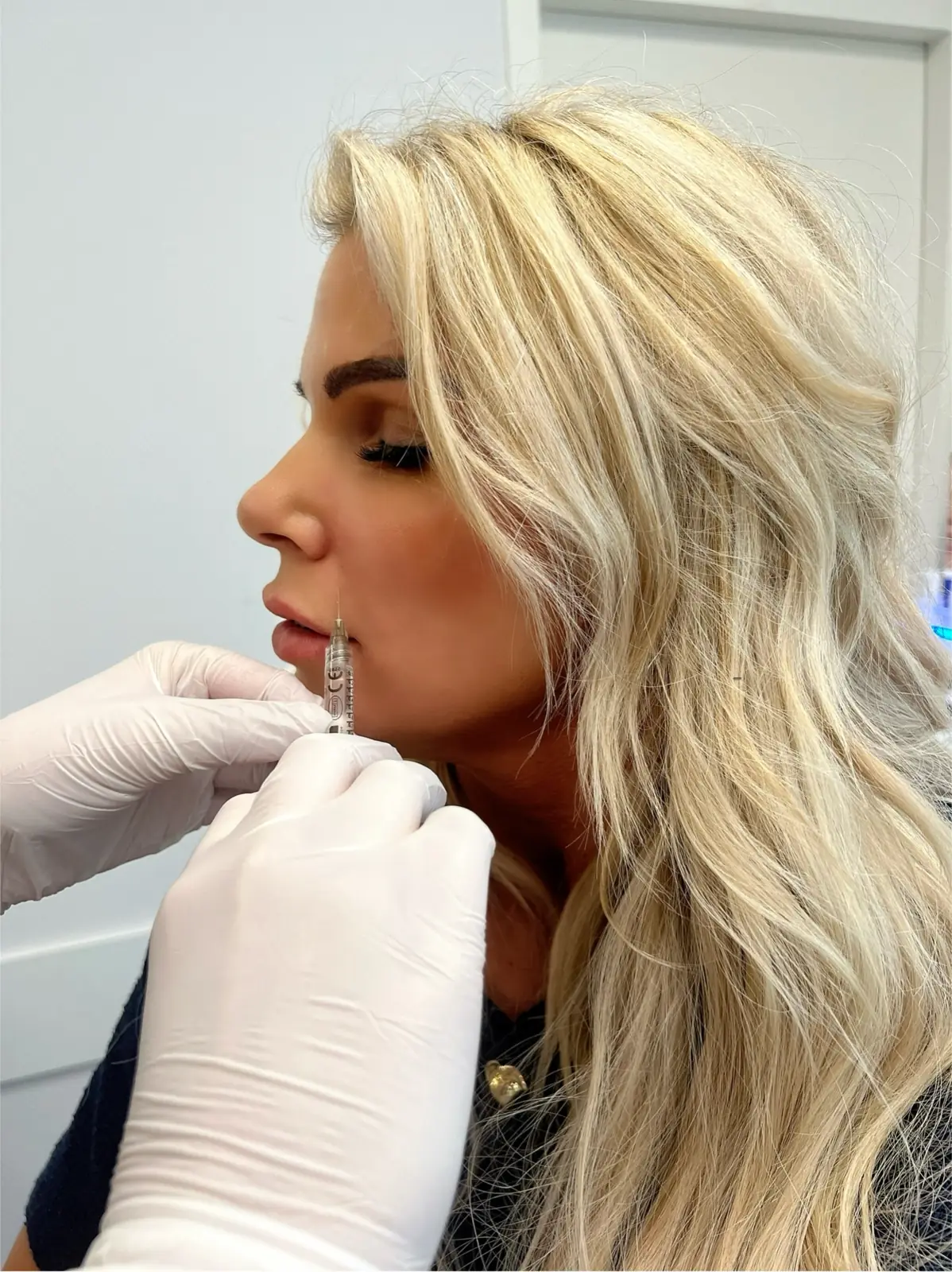 Behandeling met filler bij PerfectSkin by Laura