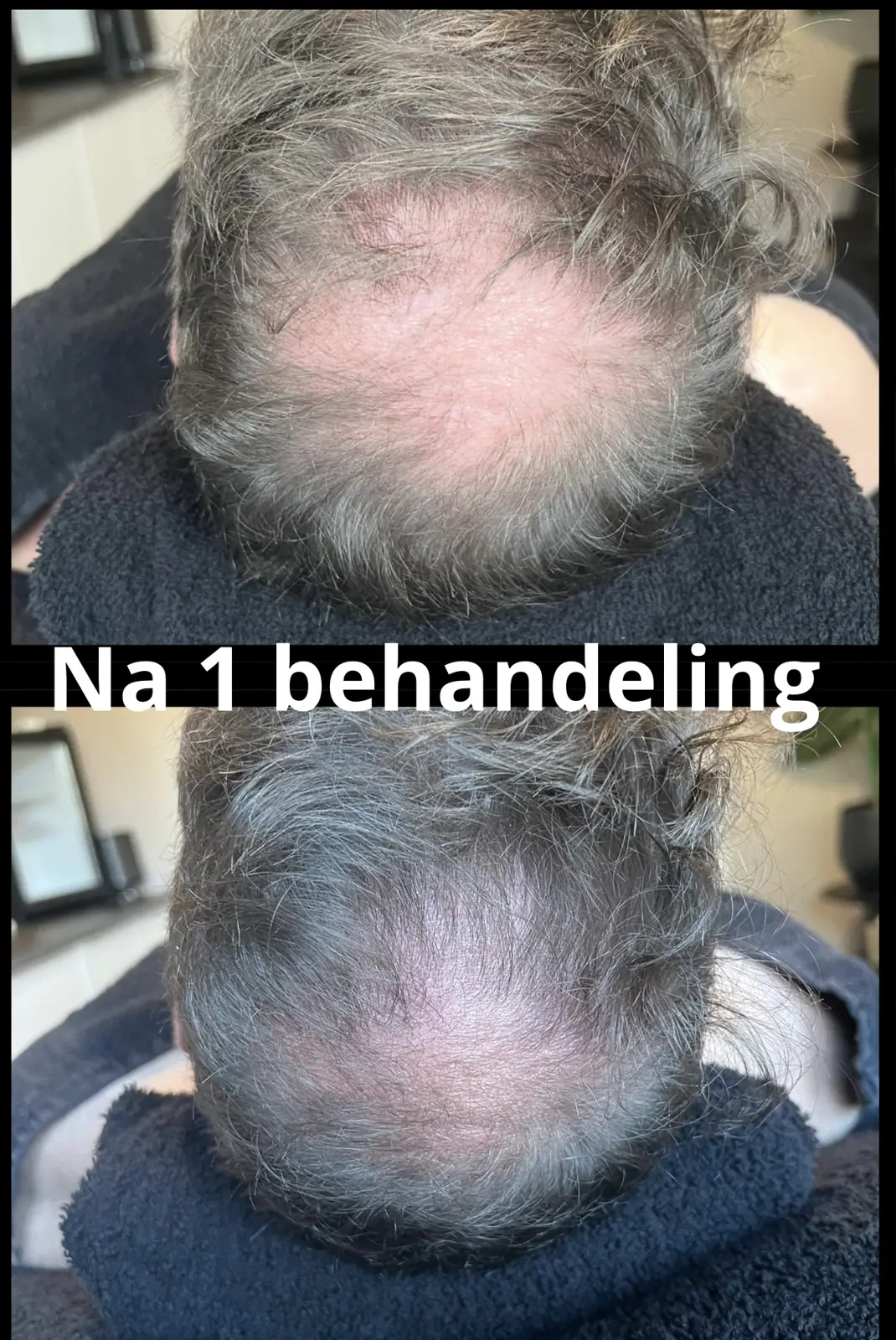 Hair Therapy, na 1 behandeling resultaat bij PerfectSkin by Laura